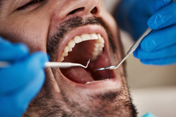Best Knocked-Out Tooth (Avulsed Tooth) Treatment in Montgomery, TX